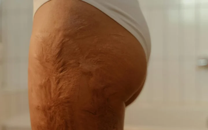 Descoperire europeană aduce un nou tratament pentru psoriazisul care afectează 400.000 de români